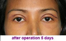 plastic-surgery-blepharoplasty